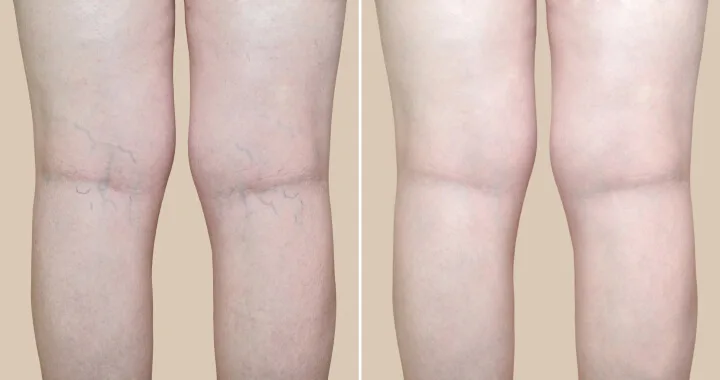 A Complete Guide to Your Non Surgical Varicose Vein