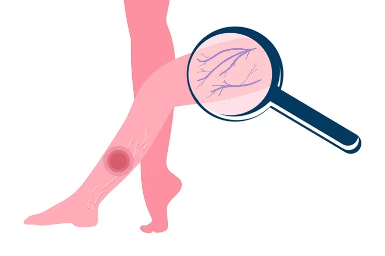 A magnifying glass showing veins in leg