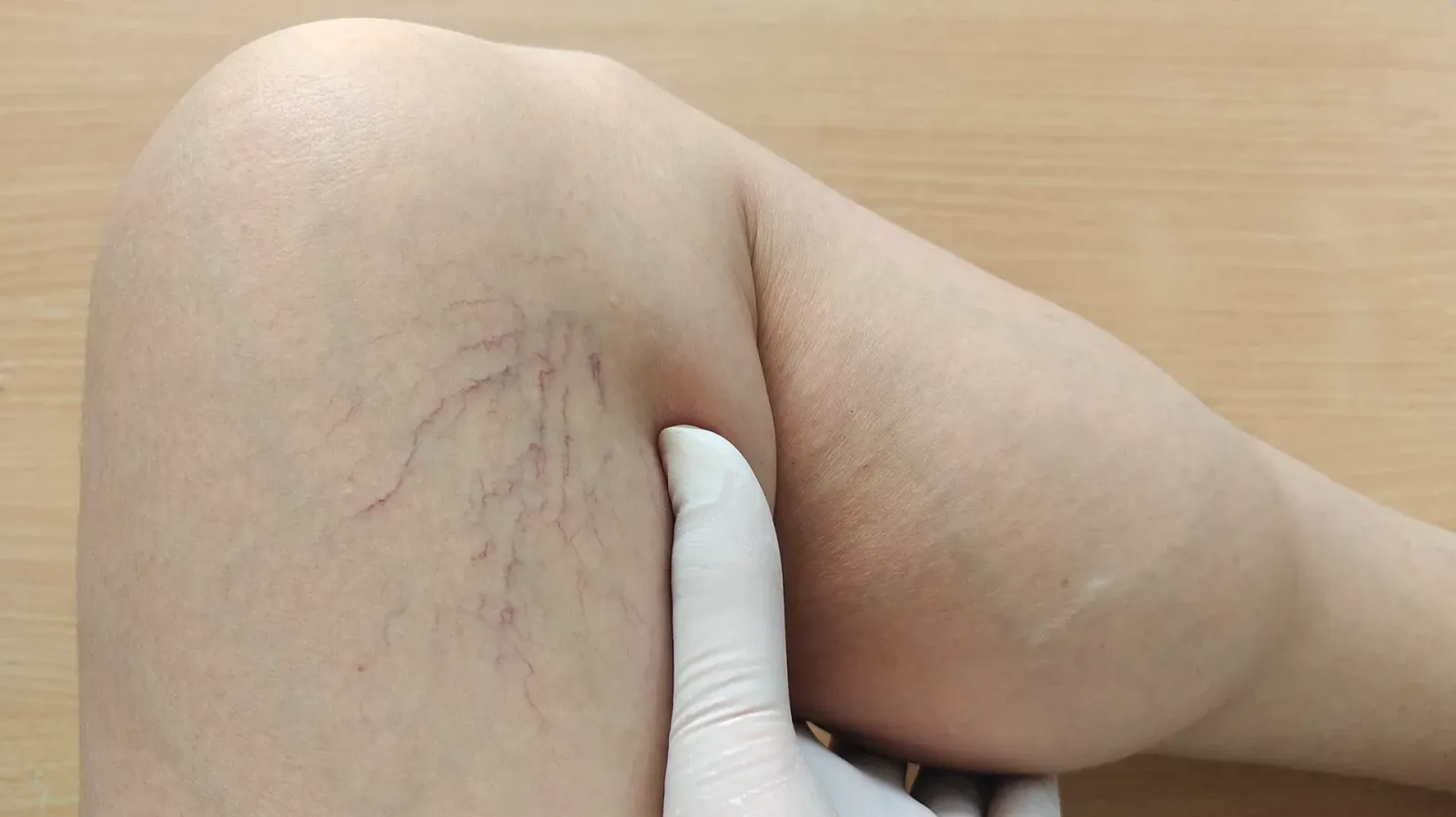 Post-Thrombotic Syndrome: Your Guide to Long-Term Life