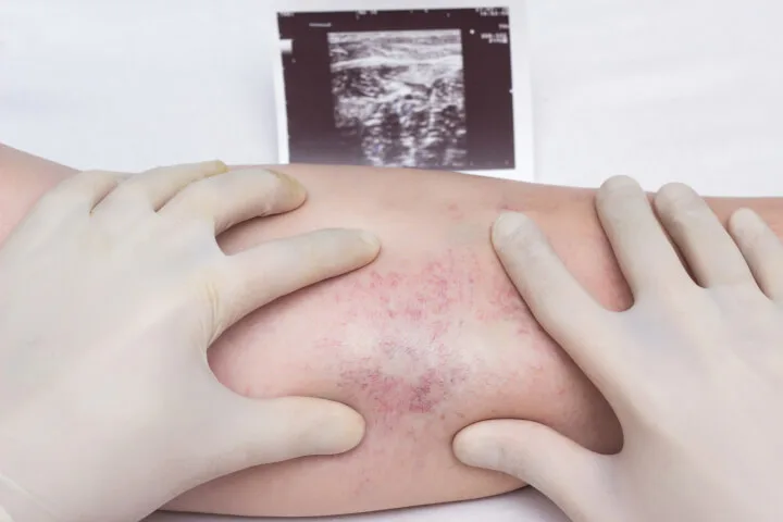 vein treatment procedure