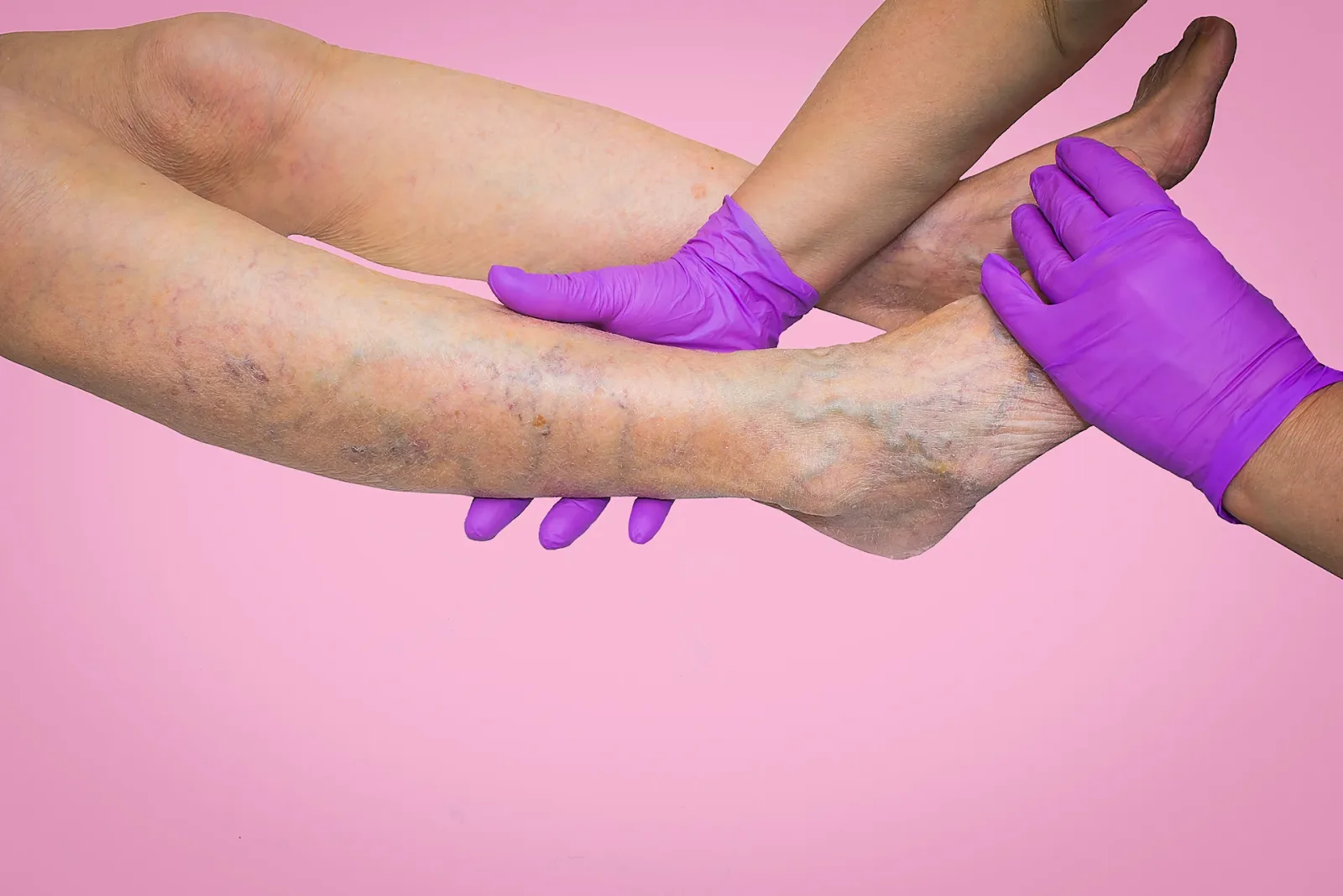 What Are the Best Treatments for Chronic Venous
