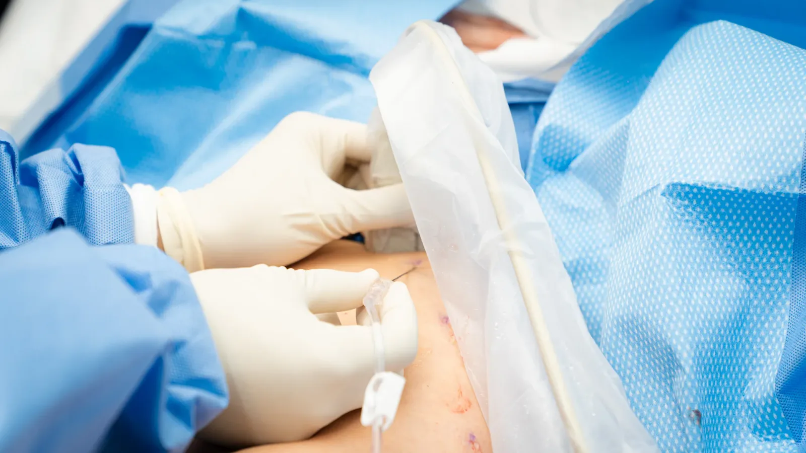 VenaSeal closure system procedure at Vein Center Doctor